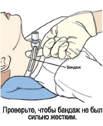трахеостома у ребенка 3 фото