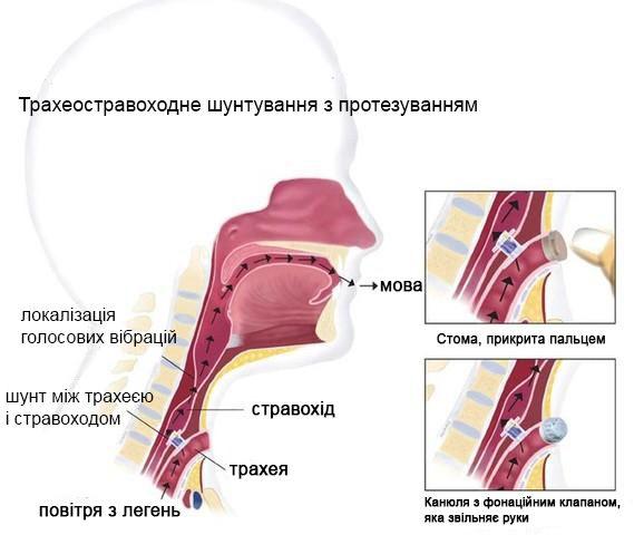 Трахеостравохідне шунтування з протезуванням