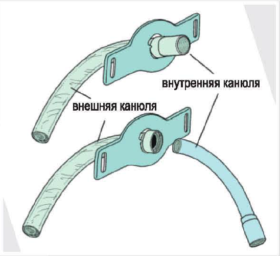 Жизнь с трахеостомой, аксессуары которые могут ее упростить ...